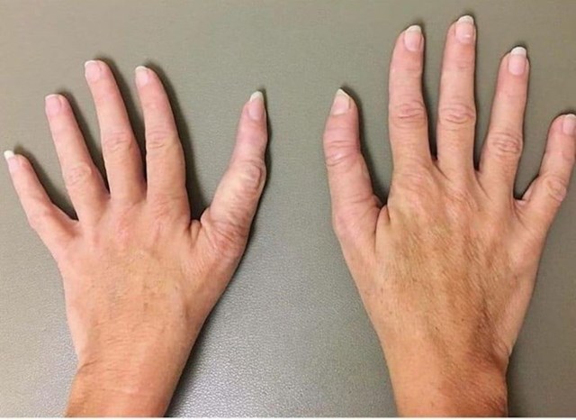 Palac jednake veličine kao ostali prsti