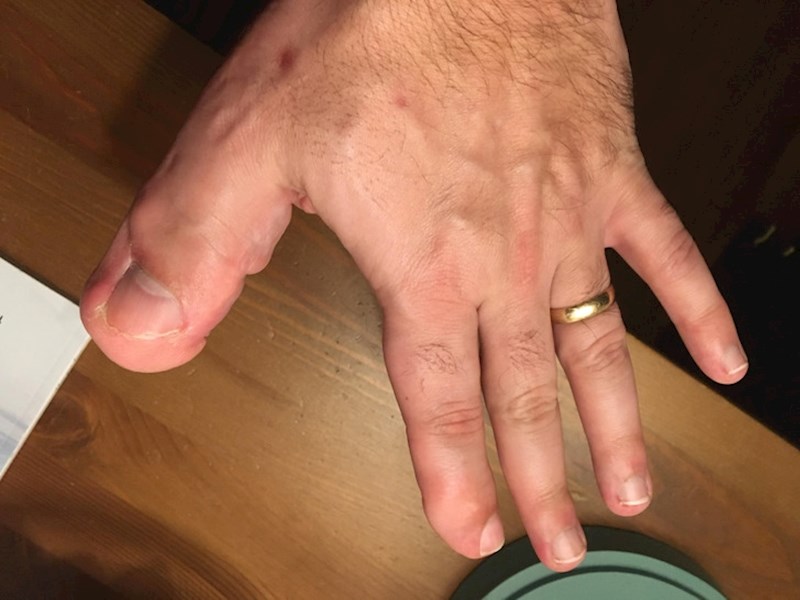 Lokalizirani gigantizam