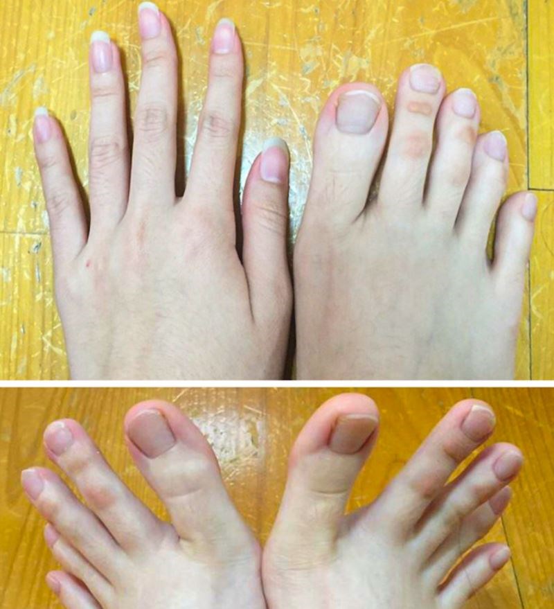 Moji nožni prsti izgledaju kao ručni