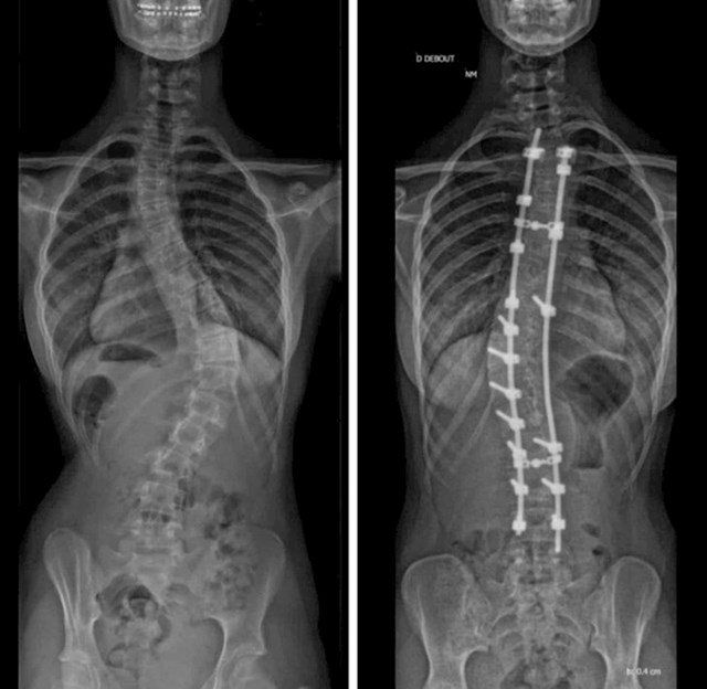 Operacija ispravljanja kralježnice ovog je pacijenta povisila za 5 cm!