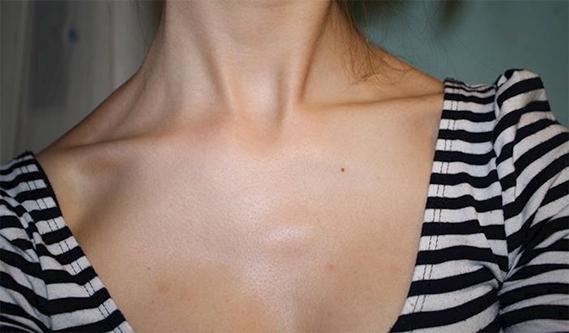 Ključna kost je dizajnirana za podnositi višestruke lomove jer je jedna od njezinih uloga zaštita kralježnice od udaraca.