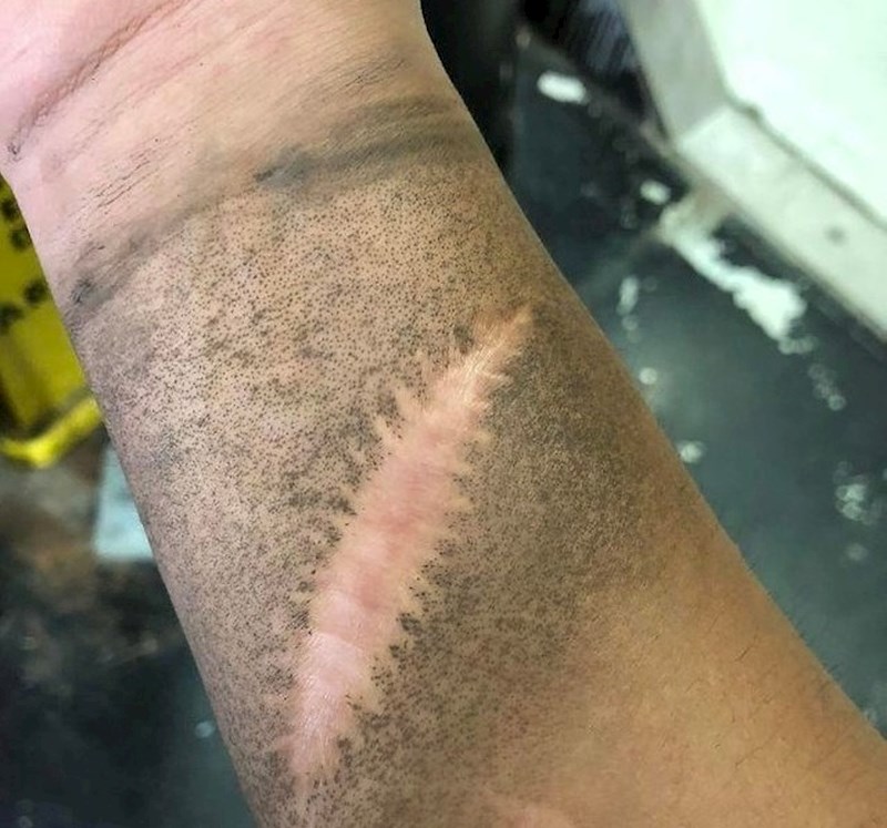 Oštećeno tkivo kože ponaša se drugačije od zdravog tkiva. Duboki ožiljci nikad ne zacijele u potpunosti