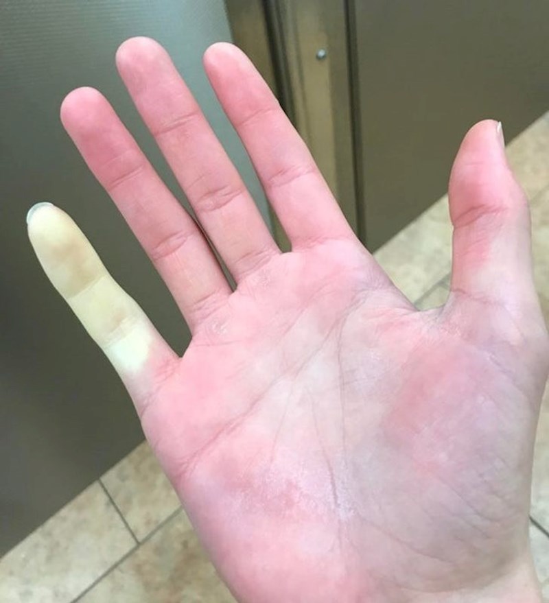 Tip je radio na hladnoći i samo je mali prst promijenio boju