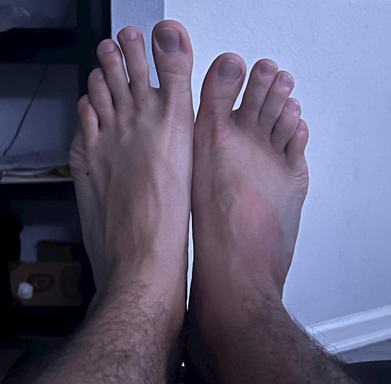 Stopala su mi baš primjetno različite veličine