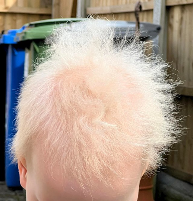 Moj sin ima 'Sindrom nečešljive kose'. To mu čini kosu super mekom, bijelom i lepršavom