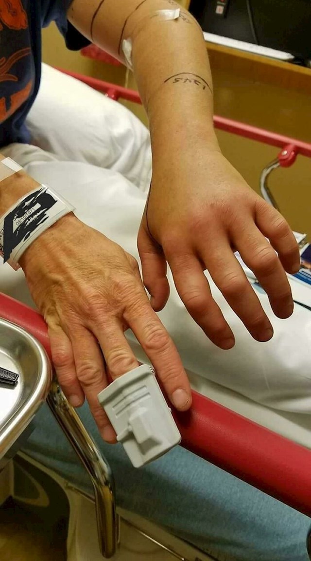 Ova baka iznenada je riješila problem naborane kože ruke, ali nikome ne bi savjetovala ovaj način. Naime, ugrizla ju je zmija otrovnica...