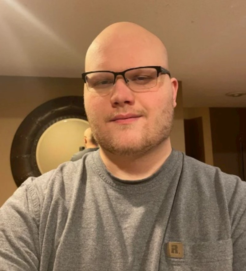 Kad počneš gubiti kosu sa 20, pa do 22 izgledaš ovako