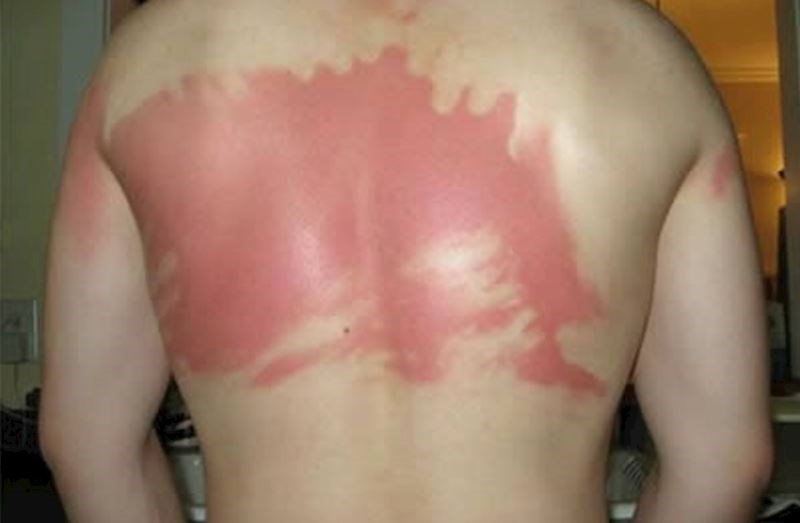 Kako prepoznati vječnog samca na plaži? Nema mu tko namazati leđa!