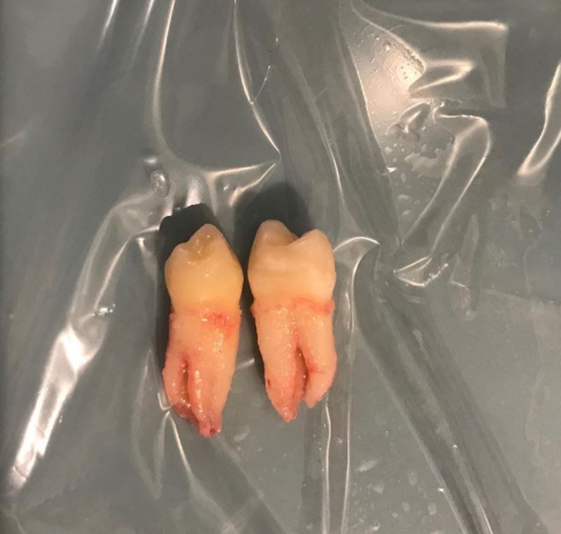 Koliki su zapravo korijeni kutnjaka