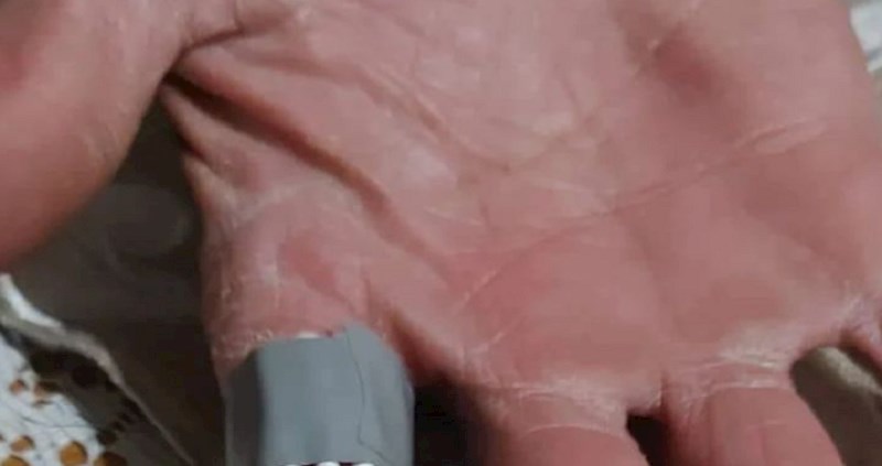 Tip je ozlijedio prst pa ga imobilizirao na urnebesan način i postao hit na društvenim mrežama