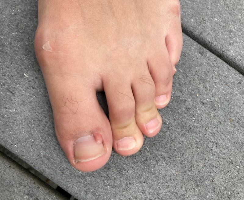 Nožni palac iz kojeg raste još jedan palac