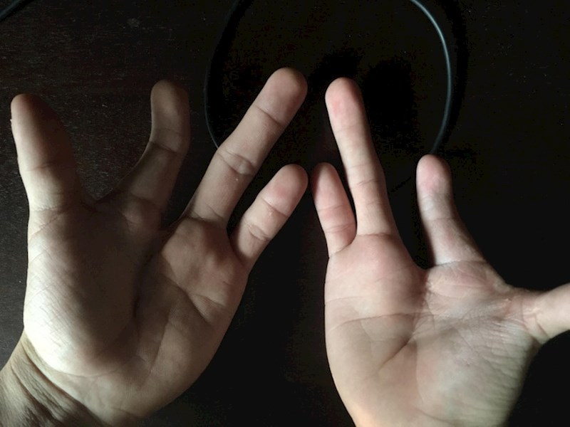 Rođen sam s po tri prsta na svakoj ruci, a moderna medicina mi je omogućila jedan dodatni prst!