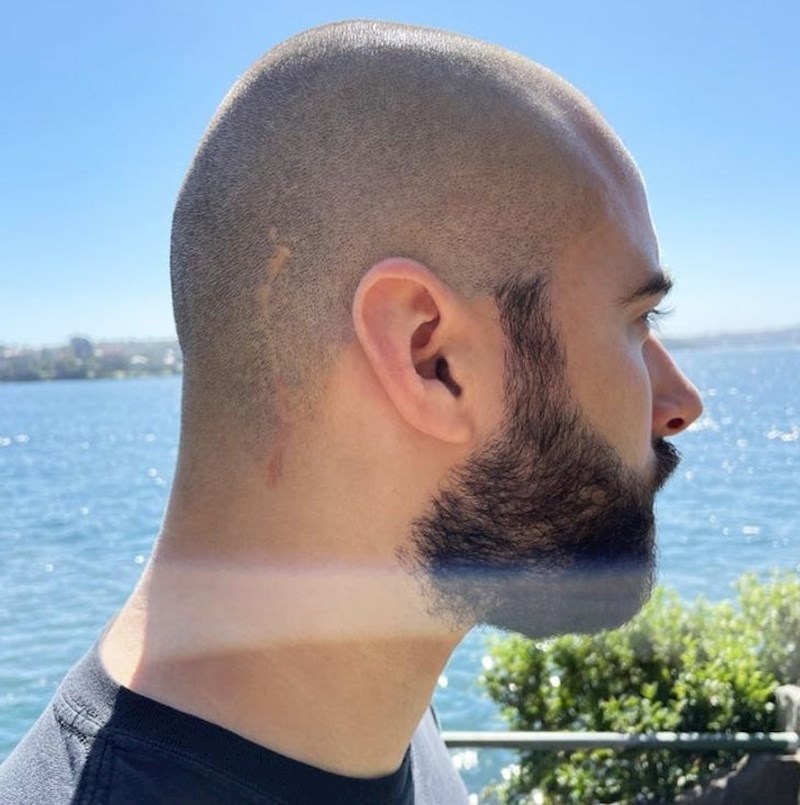 3 godine  bez tumora na mozgu. Čak je i ožiljak skoro pa nestao!