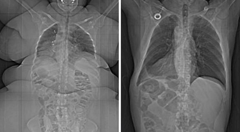 Pretila osoba vs. osoba normalne težine