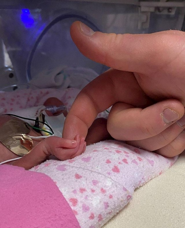 4. Beba, rođena u 27. tjednu trudnoće, drži tatu za prst