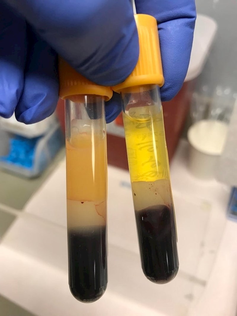 Uzorak krvi uzet prije i poslije posta