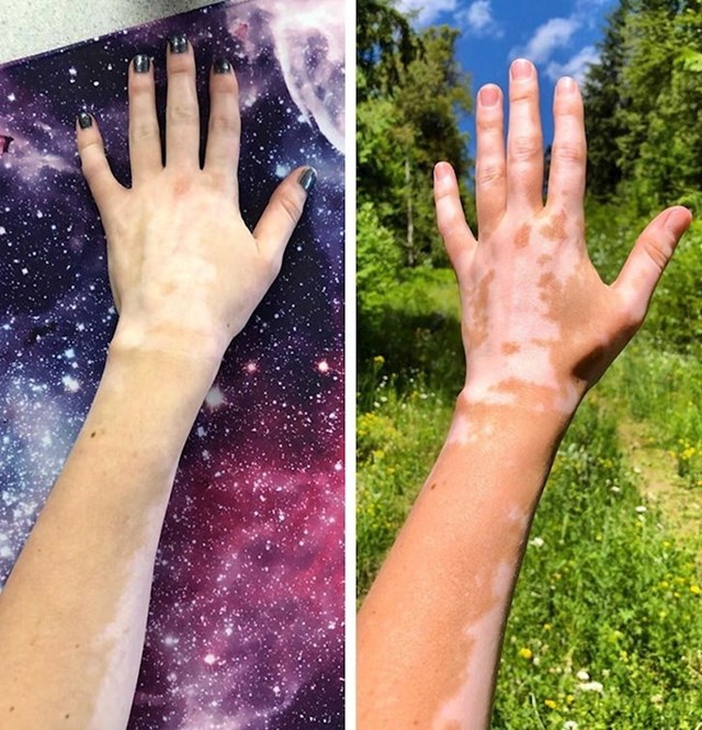 Vitiligo zimi vs. vitiligo ljeti