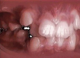 Pogledajte čudo koje u vašim ustima radi fiksni aparatić za zube