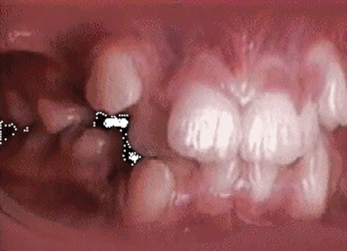 Pogledajte čudo koje u vašim ustima radi fiksni aparatić za zube