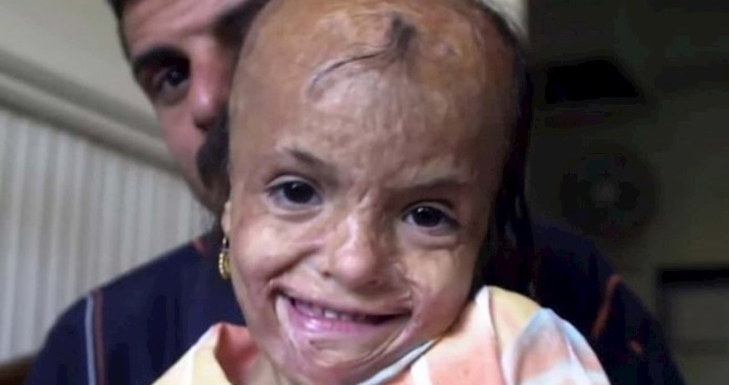 Imala je samo 5 godina kad je jedva preživjela eksploziju, njen današnji izgled je mnoge iznenadio