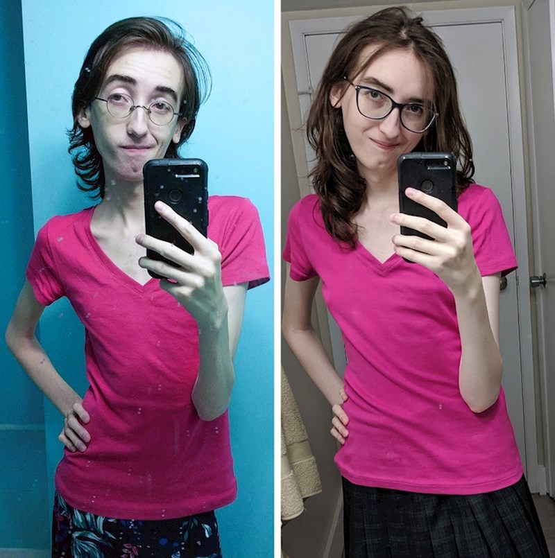 Dobila je 7 i pol kilograma u godinu dana. Svakako dobar početak za ženu s Marfan sindromom.