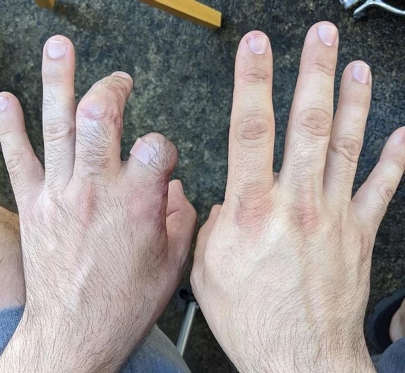 "Lijeva ruka mi je nakon nesreće 2 mjeseca bila u gipsu. Dlake su na njoj počele rasti gušće i duže."