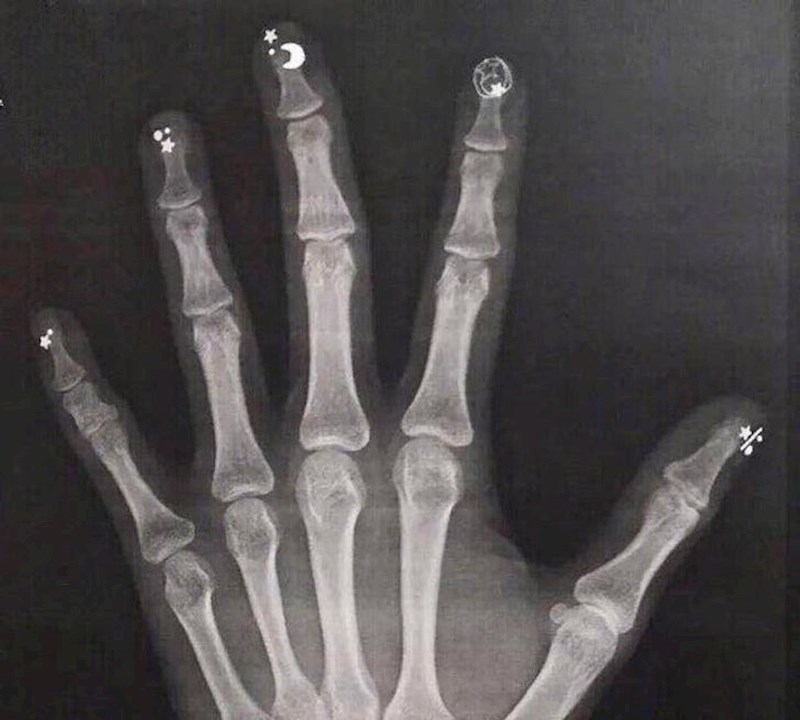 Kako rendgenska slika šake izgleda kad zaboraviš skinuti umjetne nokte s ukrasima...