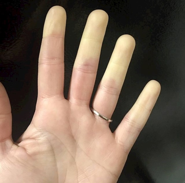 "Ovako izgleda Raynaudov sindrom na prstima."