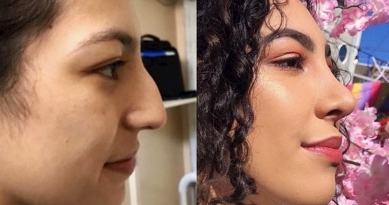 Ove fotke pokazuju zbog čega bismo trebali prestati napadati ljude koji idu na estetske operacije