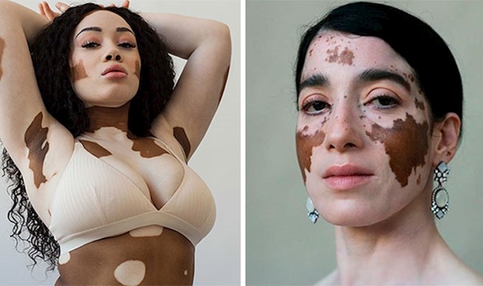 Fotografkinja s vitiligom slikala je žene s istim poremećajem i pokazala da je ovo zapravo prekrasna pojava