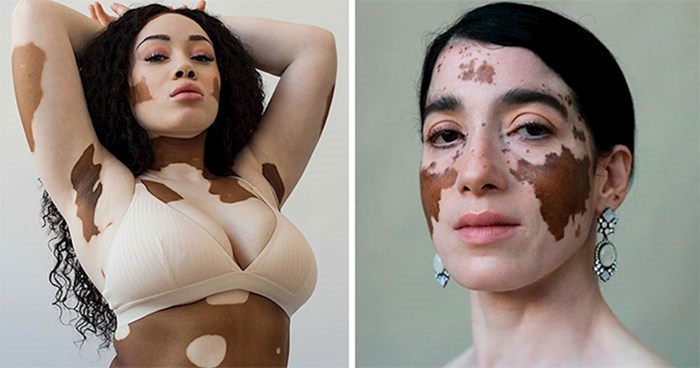 Fotografkinja s vitiligom slikala je žene s istim poremećajem i pokazala da je ovo zapravo prekrasna pojava