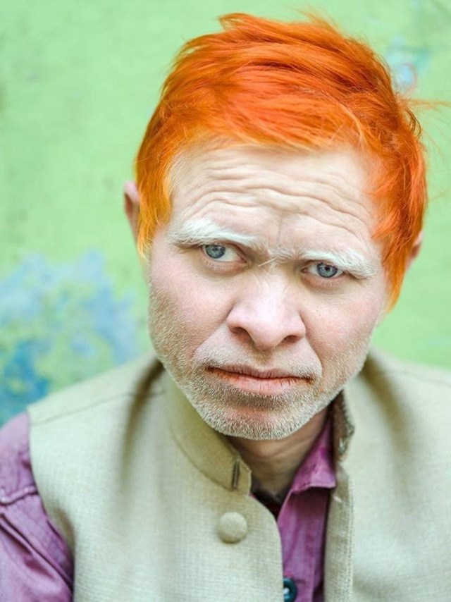 Albino muškarac iz Indije