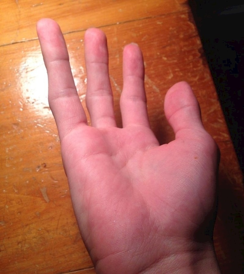Ova osoba nikad nije ni imala mali prst na rukama.