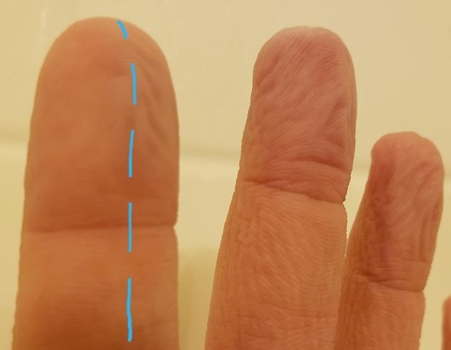 "Oštetio sam živac na kaži prstu. Sad jedna polovica prsta ne reagira kao ostali prsti kad su dugo u vodi."