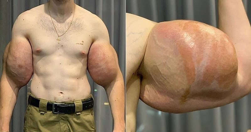 VIDEO Šokantni primjeri ljudi koji su pretjerali i postali najčudniji bodybuilderi na svijetu