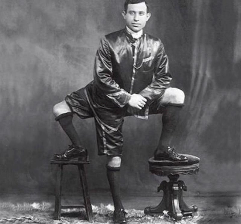 Francesco "Frank" Lentini pozira na slikanju, 1920. Imao je parazitskog blizanca kojeg je "apsorbirao" dok su još bili u mami. Zbog toga je imao 3 noge, 2 spolovila. Kasnije je imao 4 djece.