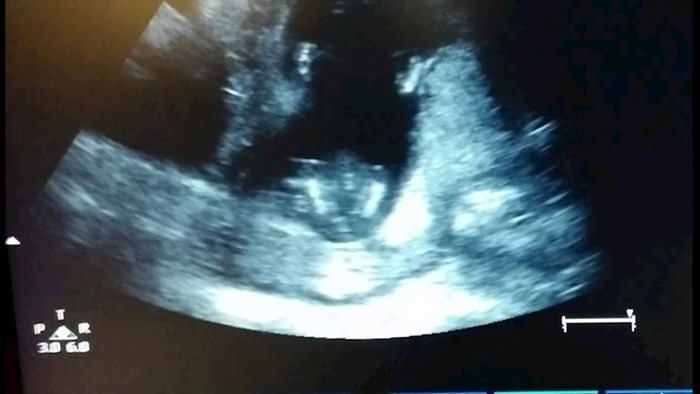 VIDEO Mladi par je gledao bebu na ultrazvuku, u jednom trenutku su primijetili nešto simpatično
