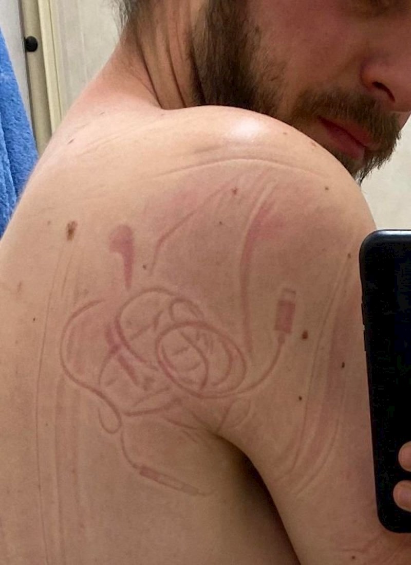 "Zaspao sam na slušalicama, kasnije mi je koža izgledala kao da je tetovirana."