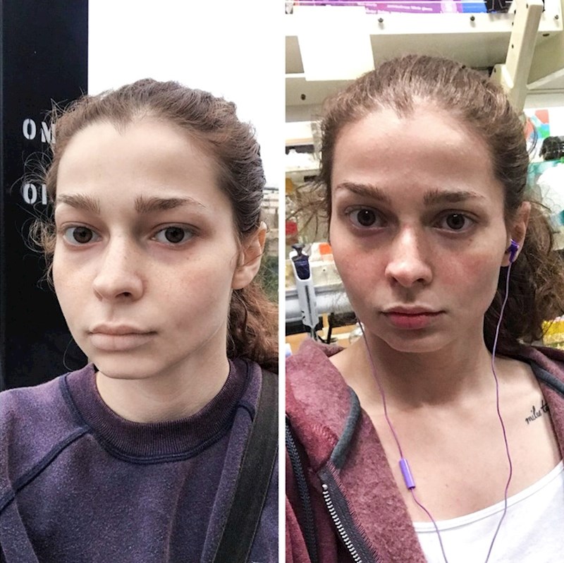 Kad je imala anemiju (slabokrvnost) / Zdrava krvna slika