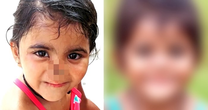 VIDEO Žena je posvojila djevojčicu kojoj su životinje pojele nos, pogledajte kako danas izgleda