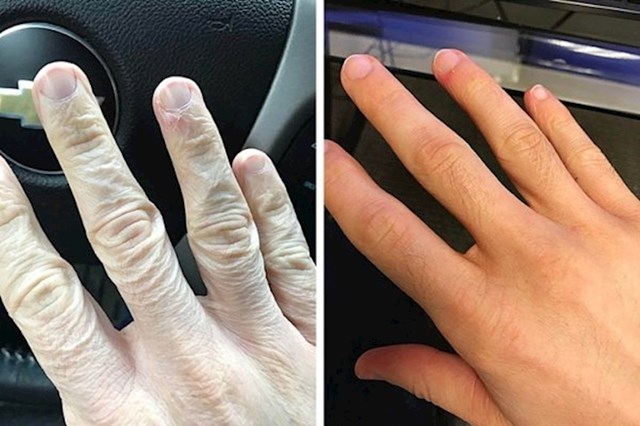 Ruka prije i nakon korištenja proizvoda za njegu kože
