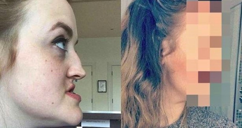 Estetska operacija joj je promijenila život, sad je više ne vrijeđaju zbog izgleda