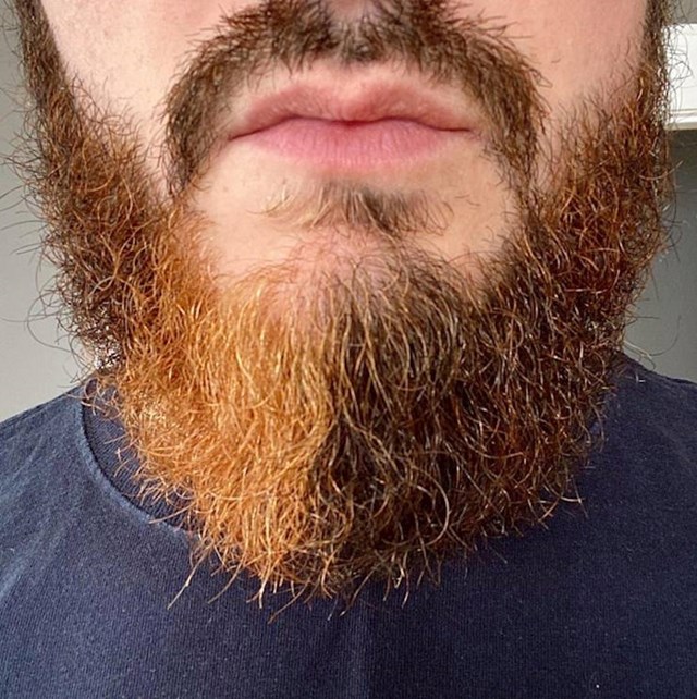 "Jedan dio brade mi je narančast, jasno se vide granice u nijansama."