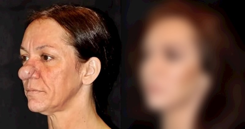 VIDEO Nos joj nije prestajao rasti, no onda je dobila operaciju koja joj je potpuno promijenila lice