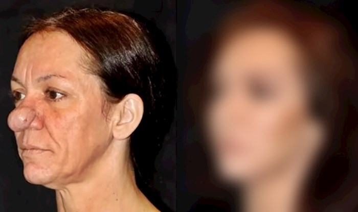 VIDEO Nos joj nije prestajao rasti, no onda je dobila operaciju koja joj je potpuno promijenila lice