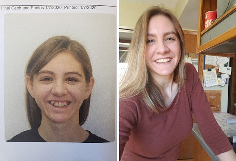 "Nakon punih 9 godina konačno sam skinula fiksni aparatić za zube."