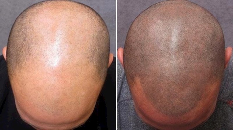 Dobra ideja za tetovažu ako ste ostali bez kose...