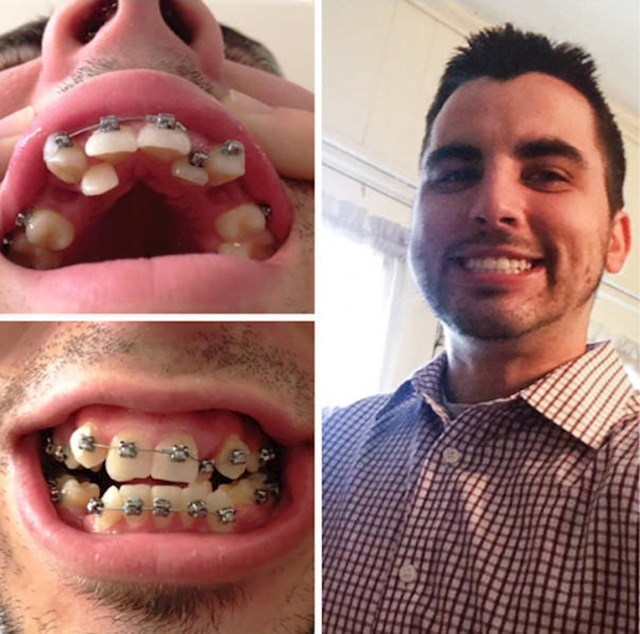 Zubi prije i nakon nošenja fiksnog aparatića