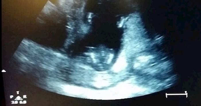 VIDEO Mladi par je gledao bebu na ultrazvuku, u jednom trenutku su primijetili nešto simpatično