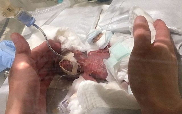 Ovaj dječačić je imao samo 268 grama kad je rođen. Nakon nekoliko mjeseci je poslan kući, potpuno zdrav.